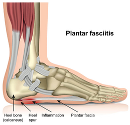 plantar-fasciitis-illustration-511e79-2338229675.png plantar-fasciitis-illustration-511e79-2338229675.png