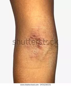 tinea-corporis-fungal-skin-infection-600w-1431236531.webp tinea-corporis-fungal-skin-infection-600w-1431236531.webp
