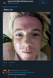 bites lip.png bites lip.png