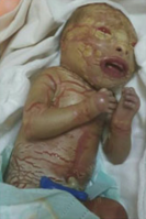 133px-Harlequin_ichthyosis.png