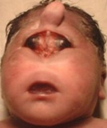 Cyclopia.jpg