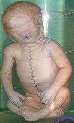 240px-Child_with_Cyclopia.jpg