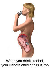 fetalalcoholsyndrome4.jpg