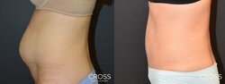abdominoplasty8-2.jpg