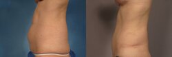 tummy-tuck-365-left-side-detail.jpg