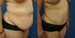 tummy-tuck-abdominoplasty-12-view-1-detail.jpg