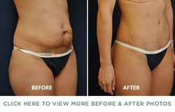 tummy-tuck-before-after-p1.jpg