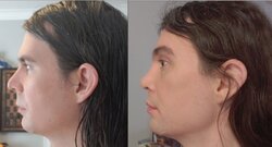 After-6-Months-Before-After-Profile.jpg