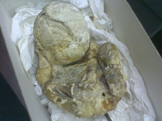 lithopedion.jpg