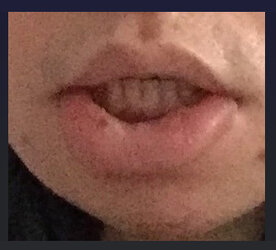 Facial_paralysis.jpg