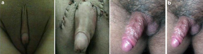 extensive metoidioplasty.jpg