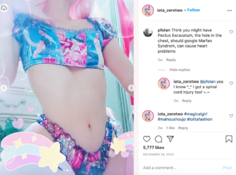 pectusexcavatum-spinalcordinjury.png
