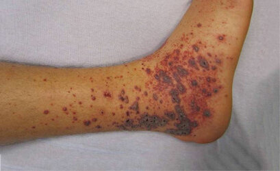 339-tissue-vasculitis.jpg
