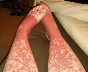 other-v-rash-in-lcv-leukocytoclastic-vasculitis.jpg
