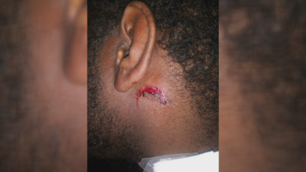 earwound.png
