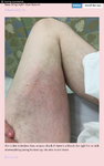 infection 3.png