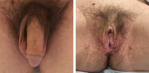 vaginoplasty-008.jpg