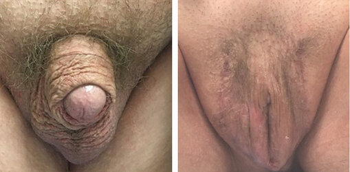 vaginoplasty-007.jpg