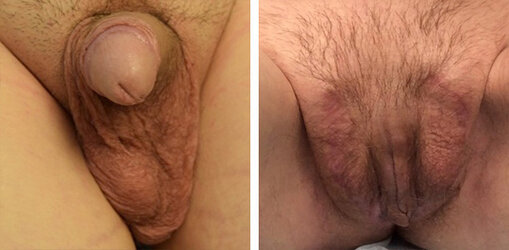 vaginoplasty-006.jpg