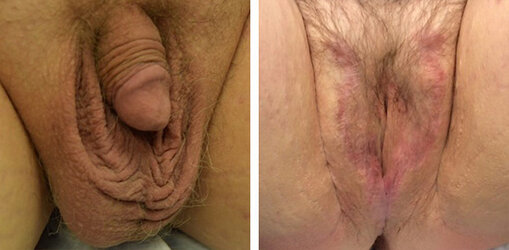 vaginoplasty-005.jpg