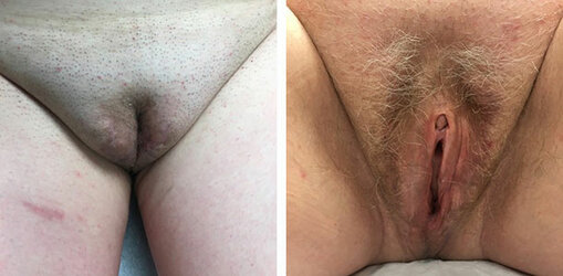 vaginoplasty-003.jpg