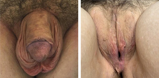 labiaplasty-002.jpg