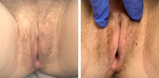 labiaplasty-001.jpg