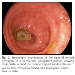 fistula.PNG