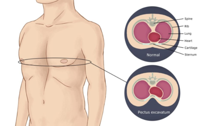 Pectus-Excavatum.png