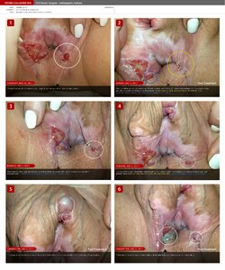 Hyper-granularization-treatment.jpg