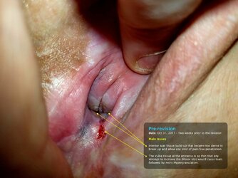 Pre-Revision-Vulva.jpg