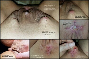 Abscess-collage.jpg