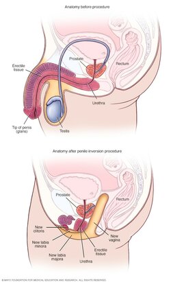 penile-inversion-8col.jpg