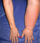lymphedema-hand.jpg