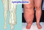 lymphedema.jpg