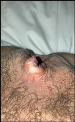 Exploding_dick.jpg