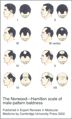 stages-og-male-pattern-baldness[1].png