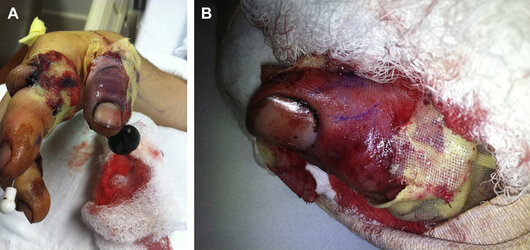 A-Placement-of-leech-on-congested-thumb-after-replantation-B-Replanted-left-thumb[1].jpg