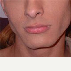 Jaw-Reduction-before-7339232-3614062.png
