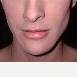 Jaw-Reduction-after-7339232-3614063.png