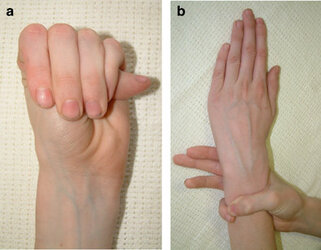 Arachnodactyly-a-positive-thumb-sign-entire-thumbnail-protrudes-beyond-ulnar-border-of.jpg