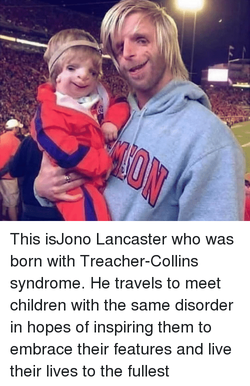 this-isjono-lancaster-who-was-born-with-treacher-collins-syndrome-he-38886309.png