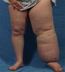 lymphedema.jpg