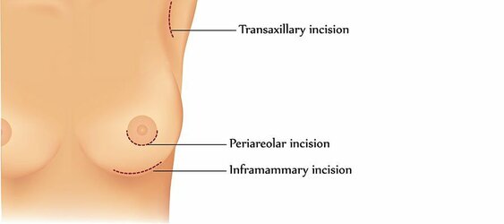 Incision-For-Breast-Augmentation-1.jpg