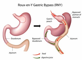 gb_obesitas_gastric_bypass.jpg