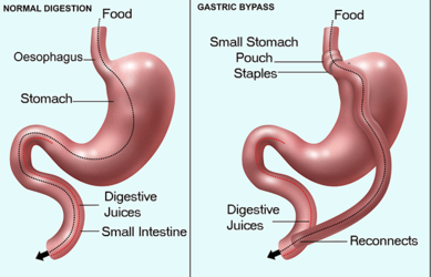 guide-to-bariatric-surgery-70c984.png
