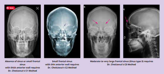 sinus cavity explanation.PNG