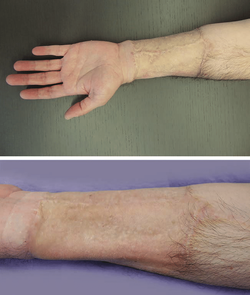 Forearm-before-and-after-Coleman-laser.png