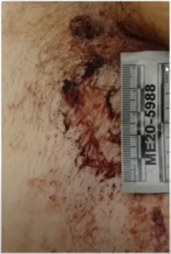 096 Rosenbaum groin.png