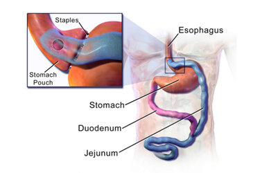 gastric_bypass.jpeg